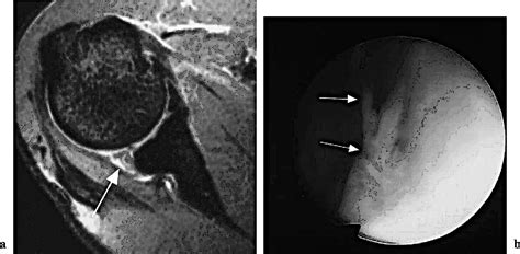 Increased Signal Intensity In The Normal Glenoid Labrum In Mr Imaging Diagnostic Pitfalls