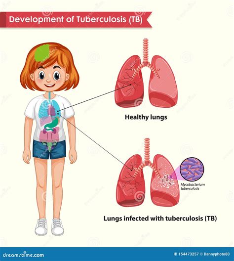 Scientific Medical Illustration Of Tuberculosis Stock Vector