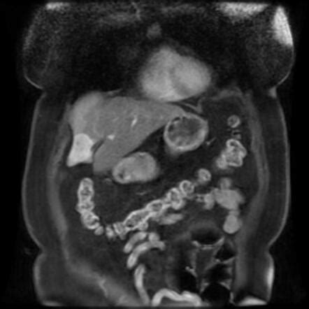 Gallbladder Carcinoma Recurrence Image Radiopaedia Org