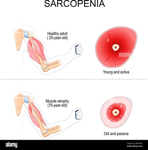 sarcopénie Comparaison et différence entre les muscles de l adulte