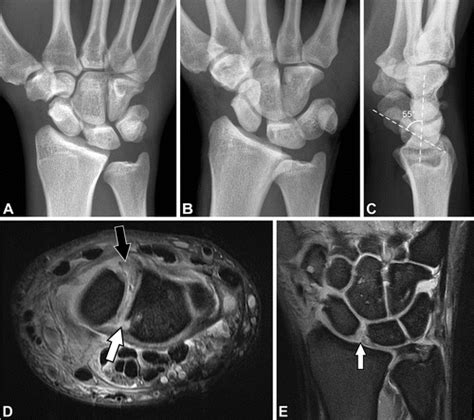 Preoperative And Postoperative Imaging Of Scapholunate Ligament Primary