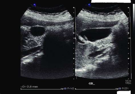 Abdominal U/S showing normal thickness of gallbladder wall. | Download ...