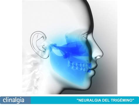 Qué Es Neuralgia Del Trigémino Tipos Y Tratamientos Clinalgia