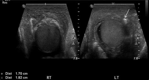 Sonographic Evaluation Of Fourniers Gangrene Kathryn M Wampler