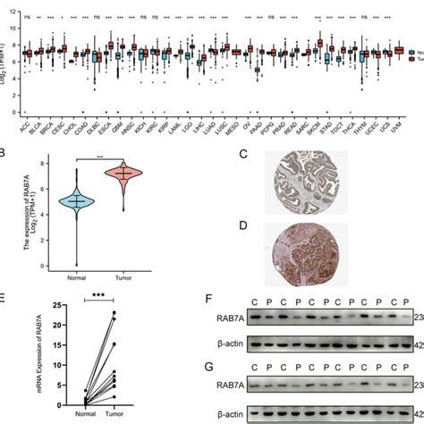 Expression Of RAB7A In Pan Cancer And PAAD A The Expression Levels