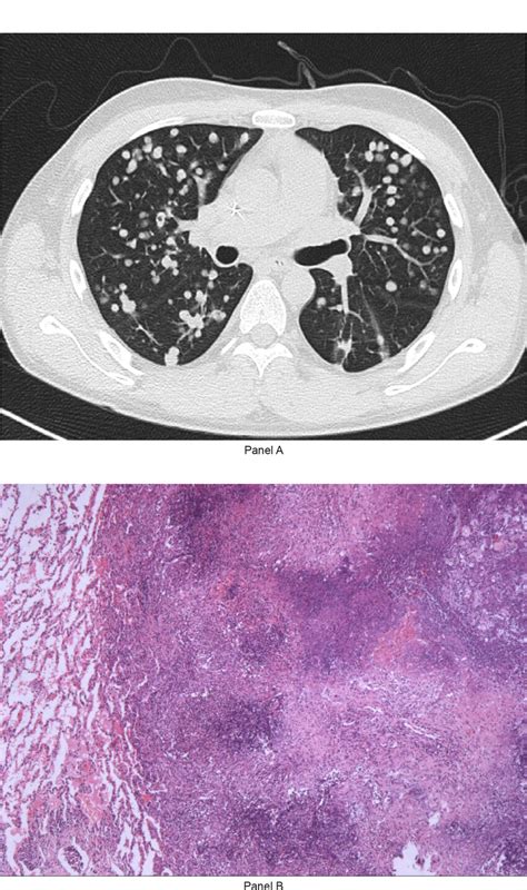 The Chest tomography (CT) scan (Panel A) demonstrated a sign of “tree ...