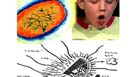 S Ntomas Y Formas De Contagio De La Tos Convulsa