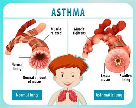 Asthma diagram with normal lung and asthmatic lung 3303538 Vector Art ...