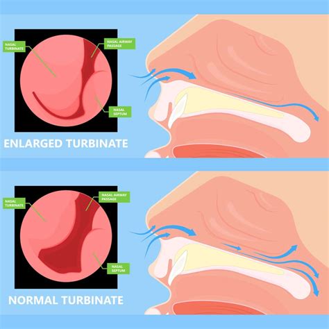 Turbinate Hypertrophy Causing Headaches | Jom Query