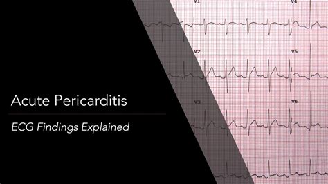 Acute Pericarditis ECG - YouTube