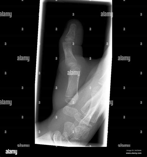 Dislocated thumb. X-ray of the right hand of a 10 year old male patient ...