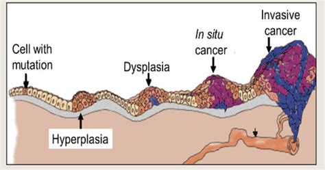 Cancer Biology Flashcards Quizlet