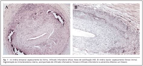 SciELO Brasil Arterite de células gigantes coronariana e infarto