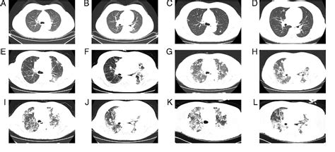 Figure From Primary Pulmonary Epithelioid Angiosarcoma With Thyroid