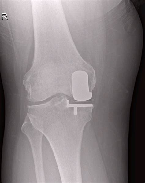 Knee Treatments Northampton Orthopaedics