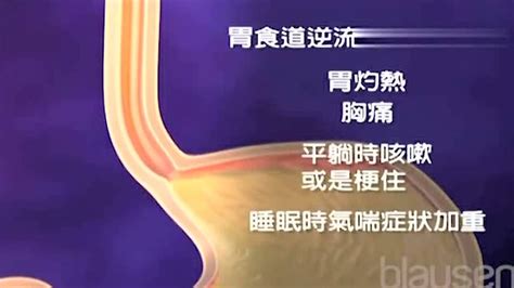 医学3d动画演示胃食管反流病及其常见症状腾讯视频