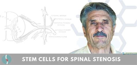 Evidence Based Stem Cell Treatment For Spinal Stenosis