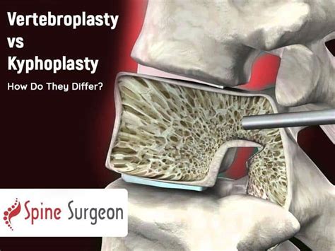 Vertebroplasty vs Kyphoplasty - How Do They Differ? | Spine Surgeon