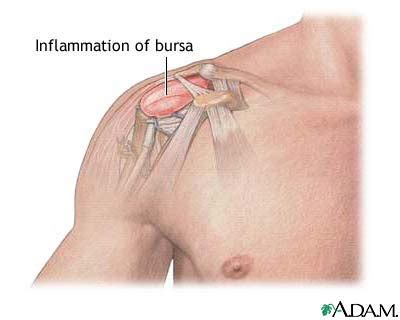 Shoulder Bursitis Treatment | 🩺Singapore Sports & Orthopaedic Surgeon