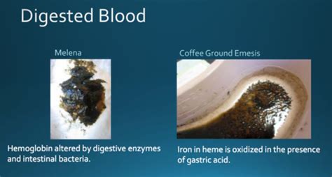 Coffee Ground Emesis