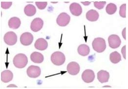 Hemolytic Anemia Flashcards Quizlet