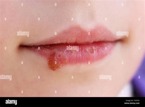 Candidiasis oral fotografías e imágenes de alta resolución Alamy