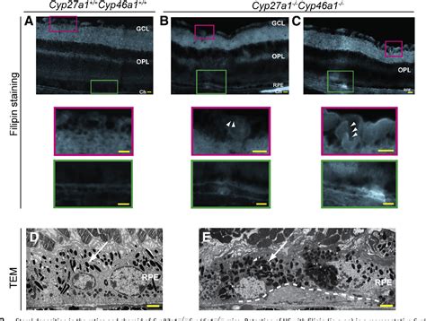 Figure 2 From Retinal And Nonocular Abnormalities In Cyp27a1