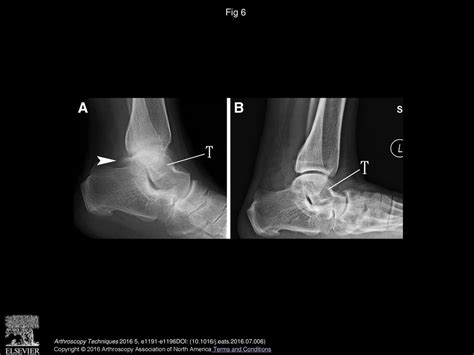 Decompression Of Posterior Ankle Impingement With Concomitant Anterior