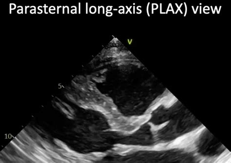 Left Ventricular Systolic Function Assessment Part 1 Of 3 OpenAnesthesia