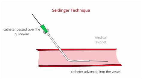 Seldinger Technique And Modified Seldinger Technique Youtube