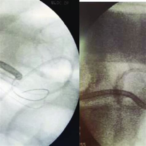 X Ray Showing The Endoscopic Internal Drainage With Double Pigtail