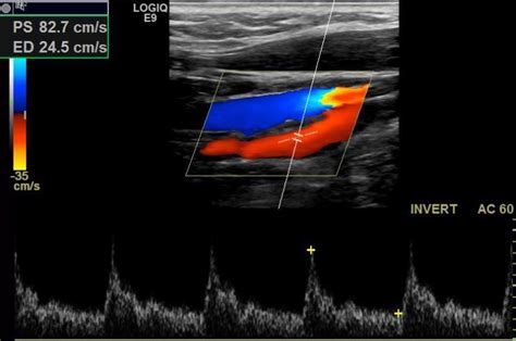 Figure Doppler And Spectral Waveform Of Ica Contributed By Kirti