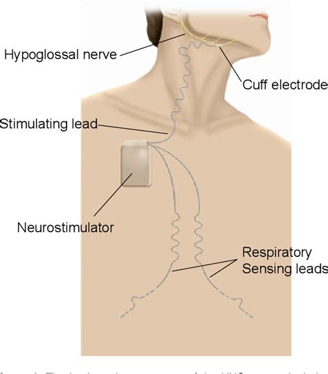 Figure 1 from Hypoglossal nerve stimulation improves obstructive sleep ...