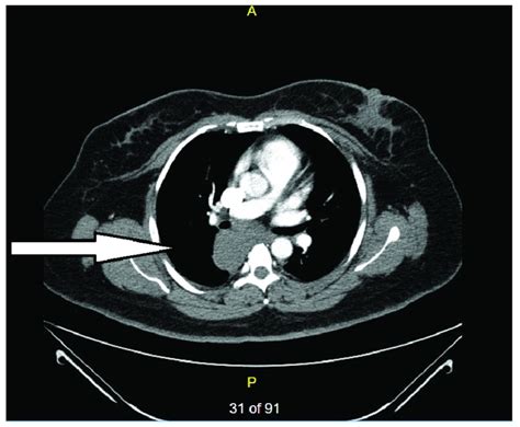 Case Report Severe Back Pain Epigastric Distress And Refractory