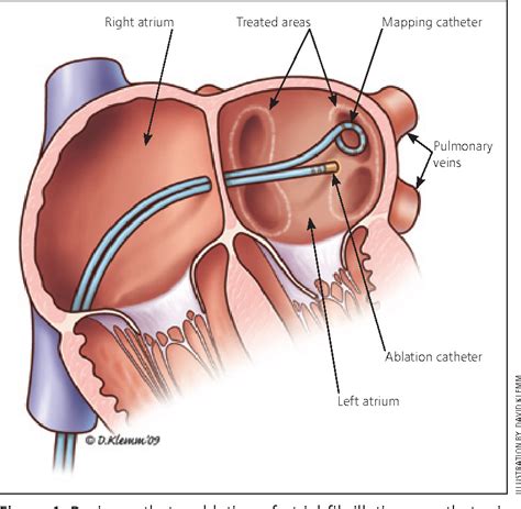 Table From Catheter Ablation Of Supraventricular Arrhythmias And