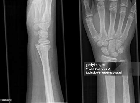 Xray Of Right Hand With Fracture Of Distal Radius 13 Year Old Male High ...