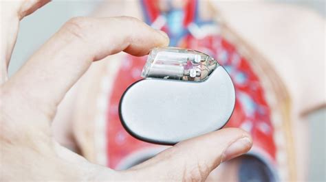 Arrhythmia Treatment and Implantable Cardioverter Defibrillator