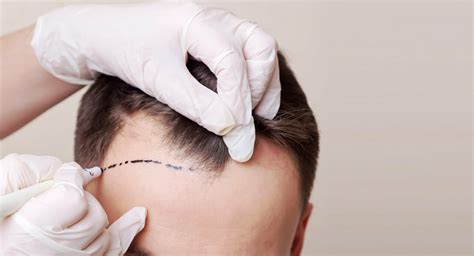 Hair Transplants All You Need To Know About Fue And Fut Hairscience