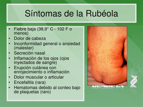 PPT Rubéola PowerPoint Presentation ID 5693828