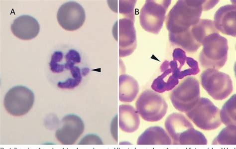 Figure 1 From Detection Of Morulae In Peripheral Blood Neutrophilsfrom