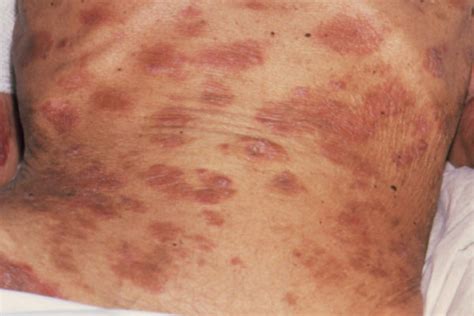 Hiv Skin Spots