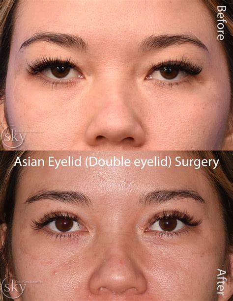 Asian Blepharoplasty Double Eyelid Surgery San Diego — Sky Facial