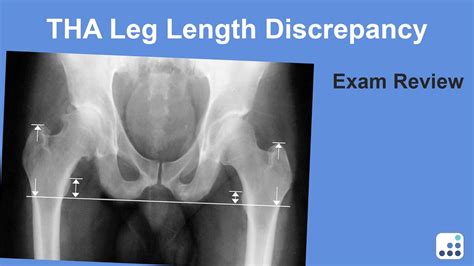 Leg Length Discrepancy Daniel Berry Md Youtube