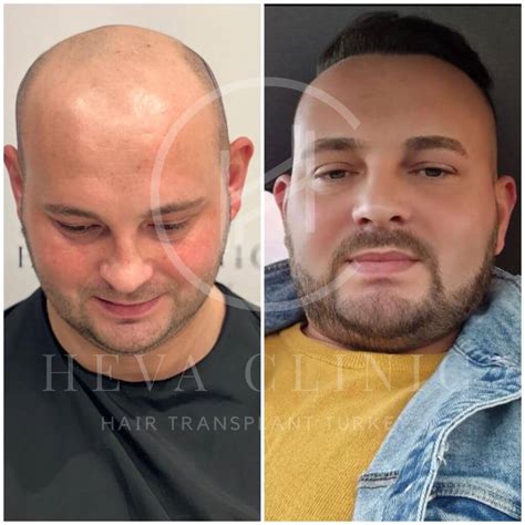 6000 Grafts Hair Transplant Turkey Cost And Process Heva Clinic