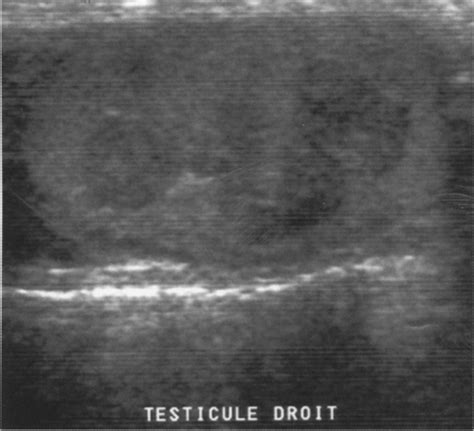 Echographie Des Testicules Avec Nodules Multiples Et Bilatdraux Une