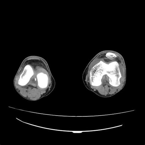 Tibial Plateau Fracture Schatzker Type Ii Image