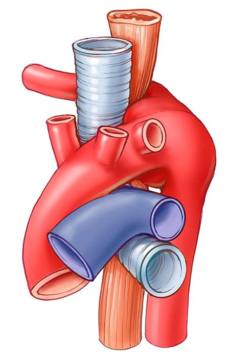 Right Aortic Arch With Aberrant Left Subclavian