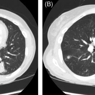 Initial Computed Tomographic Images For The Patient In Case 2 Showing