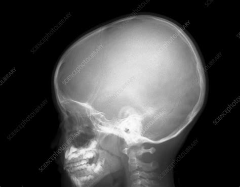 Enlarged Adenoids X Ray Stock Image F042 7350 Science Photo Library