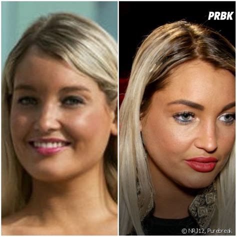 Aurélie Dotremont Les Princes Hillary Et Mélanie Dédigama Les Avant Après Chirurgie 💉